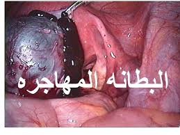 البطانة المهاجرة